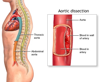Aortic Dissection North Texas Vascular Center
